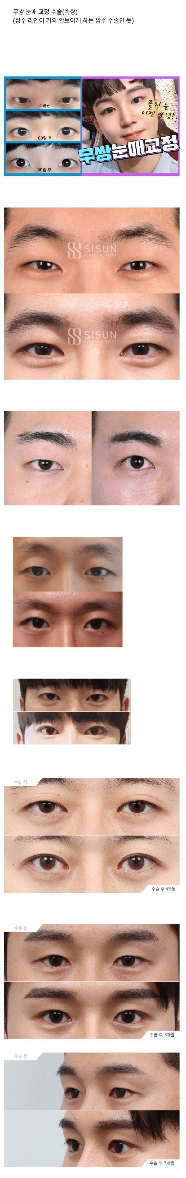 요즘 남자들 유행하는 성형수술